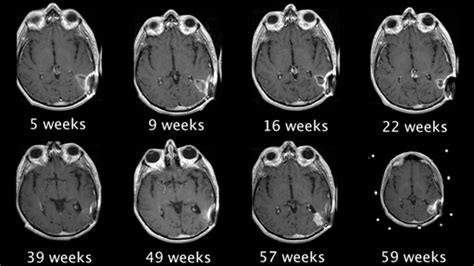 Serial Mri Gadolinium Enhanced T Weighted Images Axial Plane Of A