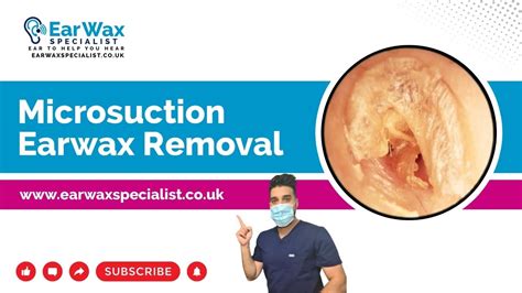 Microsuction Earwax Removal Youtube