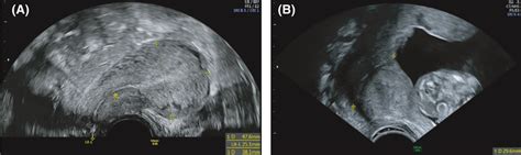 Transvaginal Sonographic Imaging Of The “neo‐cervix” A Transvaginal