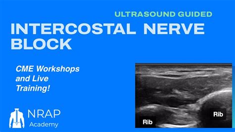 NRAP Academy Ultrasound Guided Intercostal Nerve Block For Post