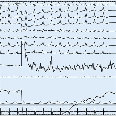 8 Termination Of Ventricular Tachycardia During Radiofrequency Download Scientific Diagram