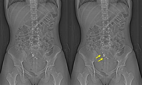 Mature ovarian teratoma – Radiology Cases