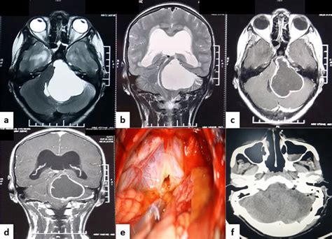 A And B Mri Brain T2 Axial And Coronal View Showing A Large