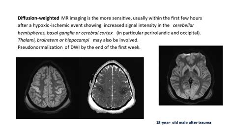 Brain MRI Imaging of an 18-year-old male after trauma showing increased ...