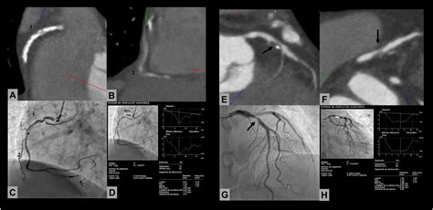 Coronary Arterial Segmental Stenosis Quantified By MDCT Correlation