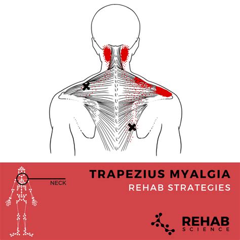 Swollen Trapezius Muscle