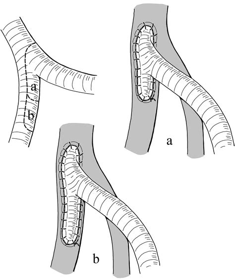 Femoro Femoral Crossover Graft And Simultaneous Reconstruction Of The Proximal Deep Femoral