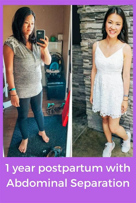 1 Year Postpartum Diastasis Recti Before And After Picture