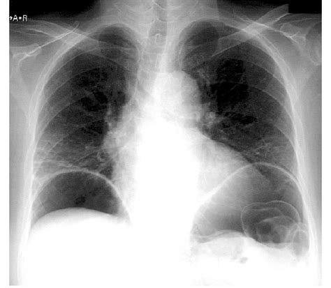 Free Gas Is Seen Below The Diaphragm On Plain Chest Roentgenogram Taken