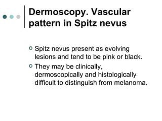 Spitz nevus | PPT