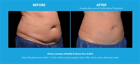 Coolsculpting Dermatology Consultants