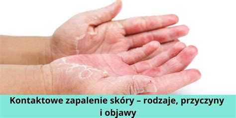 Kontaktowe Zapalenie Sk Ry Rodzaje Przyczyny I Objawy