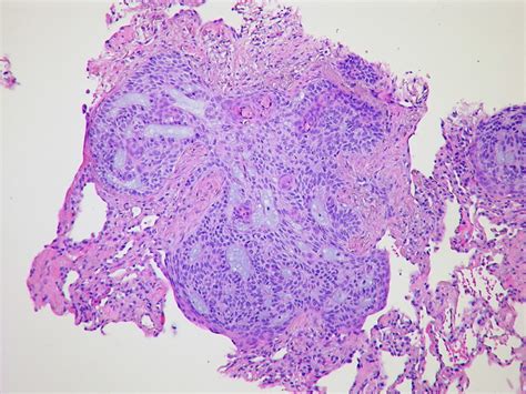 Basaloid Squamous Cell Carcinoma Case 275 Biopsy Tumor Cel… Flickr