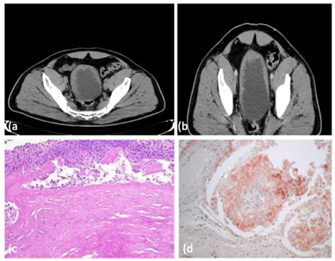 A B Ct Scan Reveals Diffuse Irregular Thickening Of Walls Of Urinary