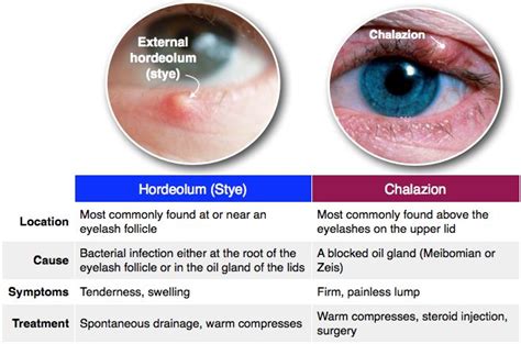 Hordeolum Vs Chalazion Anatomy Optometry School Nursing