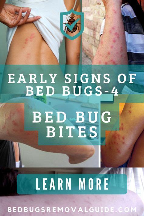 You Will Not Notice Bed Bugs Biting You During The Bite A Natural Anesthetic Is Injected Into