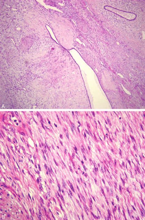 Malignant Phyllodes Tumor Of The Breast A Epithelial And Stromal