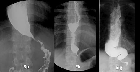 Esophageal Achalasia Treatment