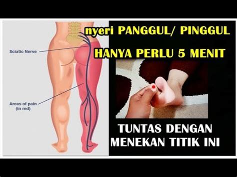 Cara Mengatasi Bokong Atau Panggul Nyeri Menjalar Ke Paha Hingga Kaki