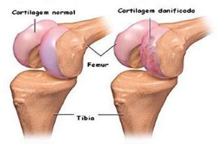 cartilagem Centro de Preservação Articular Dr Marcio Rubin