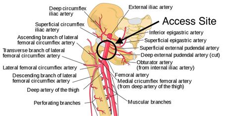 Groin Angiography Part 1 Preparation And Procedure