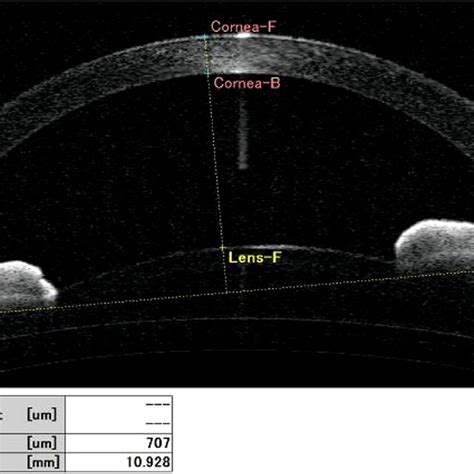 A Swept Source Anterior Segment Optical Coherence Tomography Image Of