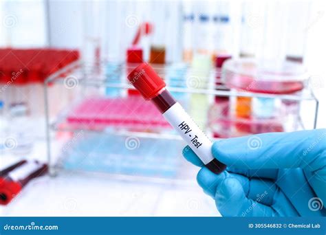 HPV Test To Look For Abnormalities From Blood Stock Photo Image Of