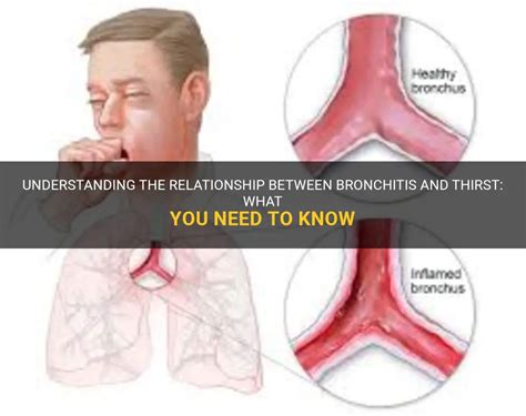 Understanding The Relationship Between Bronchitis And Thirst What You Need To Know Medshun