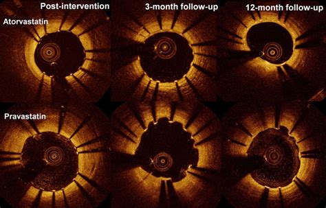 Effect Of High Dose Statin Therapy On Drug Eluting Stent Strut Coverage