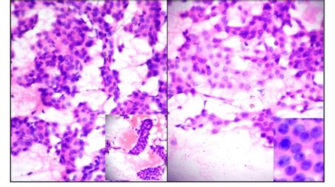 A Cytology Smears Showing Tumor Cells In Clusters Sheets And Tubule Download Scientific