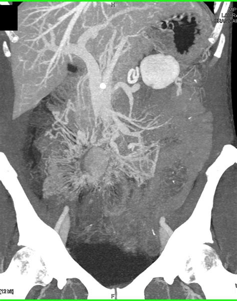 Carcinoid Tumor With Mesenteric Mass And Desmoplastic Reaction And