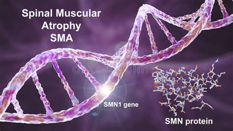 Atrophie Musculaire Spinale Sma Un Trouble Neuromusculaire Génétique