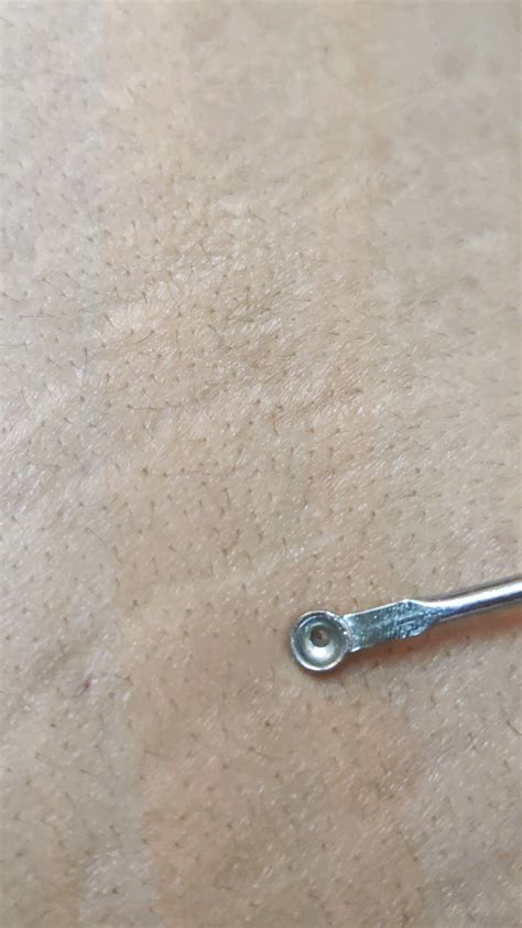 Blackhead from the back. : r/popping