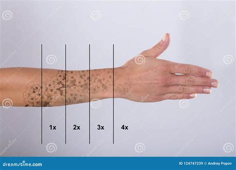 Laser Tattoo Removal on Woman`s Hand Stock Image - Image of person ...