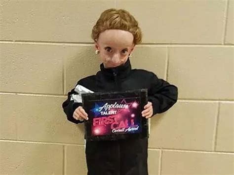 Progeria la extraña enfermedad que provoca envejecimiento prematuro