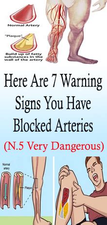 Here Are 7 Warning Signs You Have Blocked Arteries Health Tips