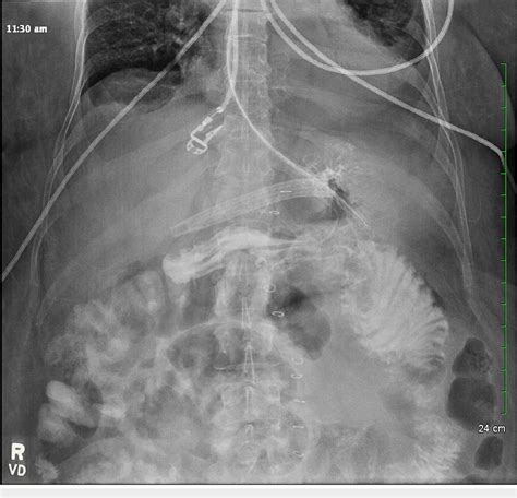 Figure 3 From Repair Of A Perforated Marginal Ulcer Seven Years After