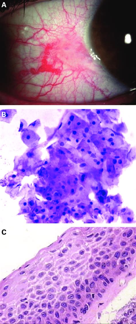 A Clinical Picture Of An Actinic Keratosis Ak From Conjunctiva B Download Scientific