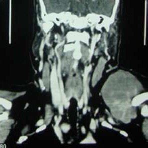 Mass over the Left supraclavicular fossa | Download Scientific Diagram