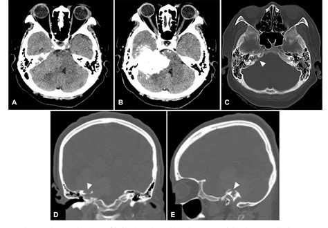 Figure From Preoperative Transarterial Embolization Of A Large