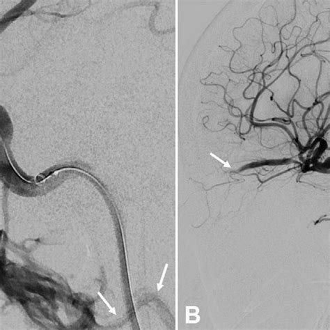 Pre Embolization Digital Subtraction Angiography With Close Up View