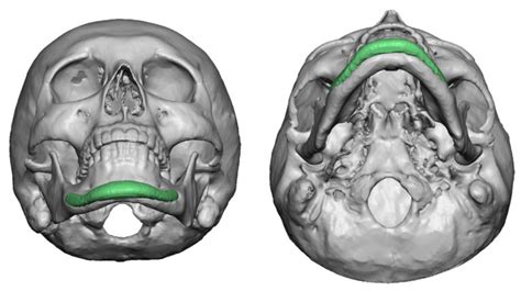 3d Ct Scan Of Posterior Zygomatic Arch Osteotomies Dr Barry Eppley