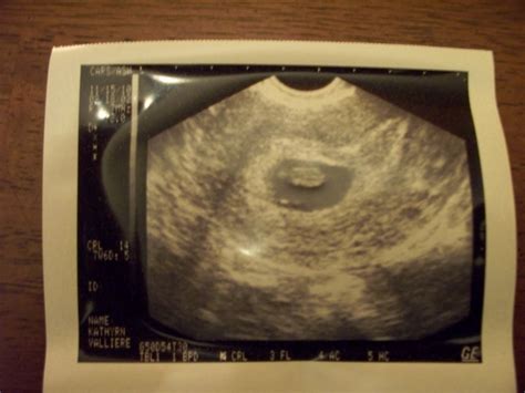 Journey to Parenthood: 7 weeks 3 days ultrasound!