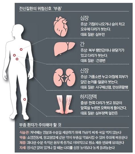 건강한 당신 다리·얼굴 ‘퉁퉁 숨이 ‘턱턱심부전·간경변·콩팥병 적신호죠 중앙일보