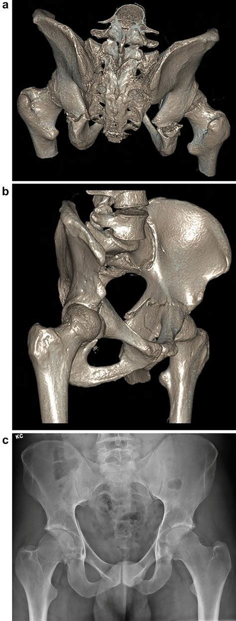 3d Surface Rendered Ct Reconstruction Images Posterosuperior View A Download Scientific