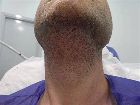 Fue Body Hair Transplant Bht