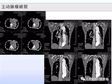 服！放射科主任总结的5大类医学影像危急值（建议收藏） 知乎