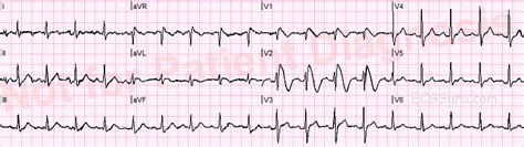 Brugada Pattern | ECG Guru - Instructor Resources