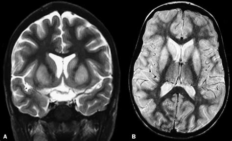 Caudate Nucleus Mri