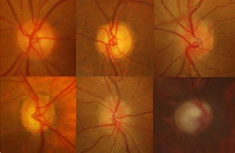 Figure 11 From Optic Disk And Cup Segmentation From Monocular Color